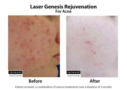 Before And After Laser Genesis Acne