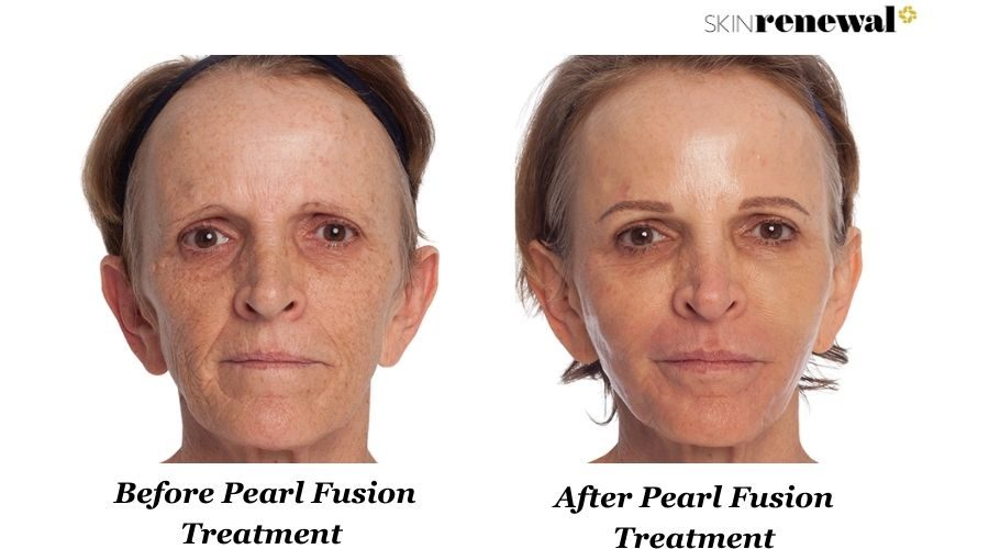 Liana Before And After Pearl Fusion