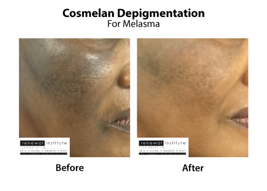 Medical Peels Cosmelan Depigmentation Melasma Treatment Skinrenewal 1