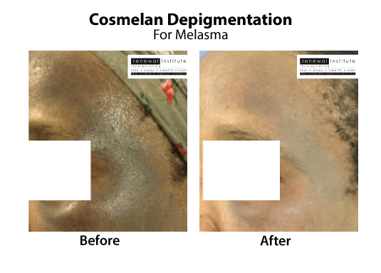 Medical Peels Cosmelan Depigmentation Melasma Treatment Skinrenewal