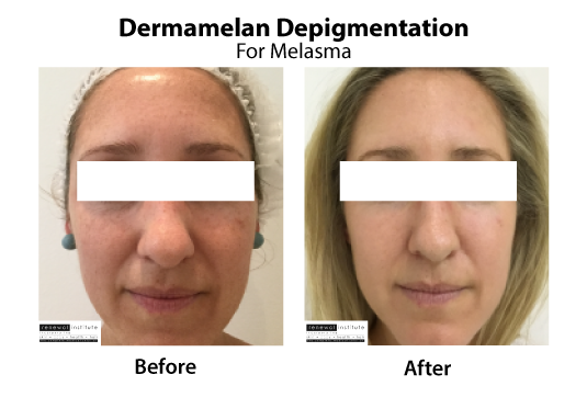 Medical Peels Dermamelan Depigmentation Melasma Treatment Skinrenewal 2