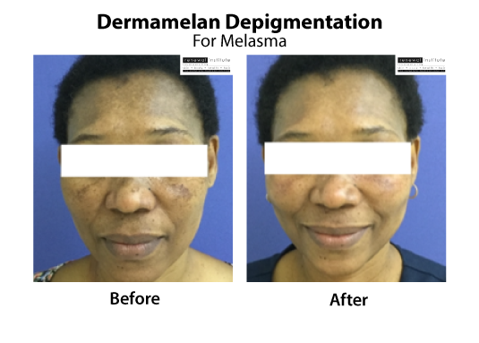 Medical Peels Dermamelan Depigmentation Melasma Treatment Skinrenewal 3