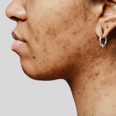 Melasma & Deep Pigmentation Solutions