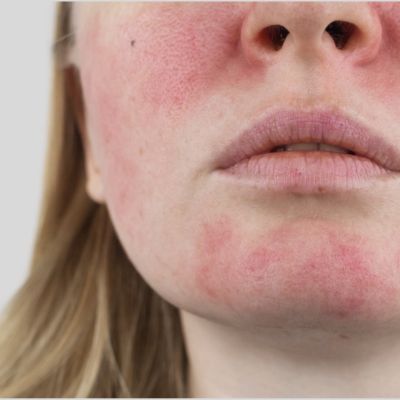 Rosacea, Redness & Sensitivity Solutions