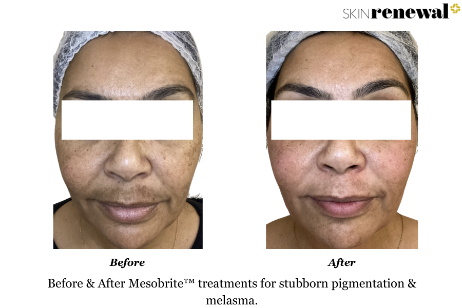Melasma Mesobrite Front Before and After
