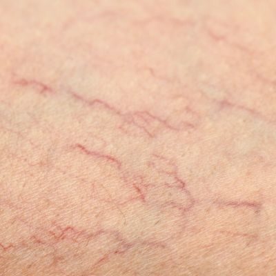 Prices - Laser Vein Removal Solutions