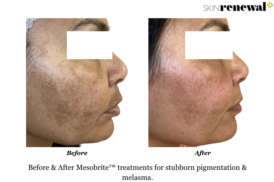 Melasma Mesobrite Right Before and After