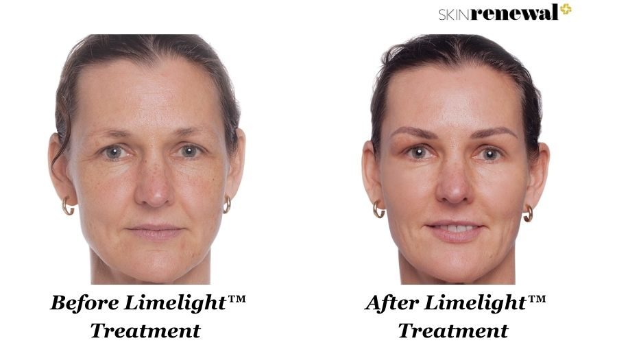 Gerda Limelight Before And After