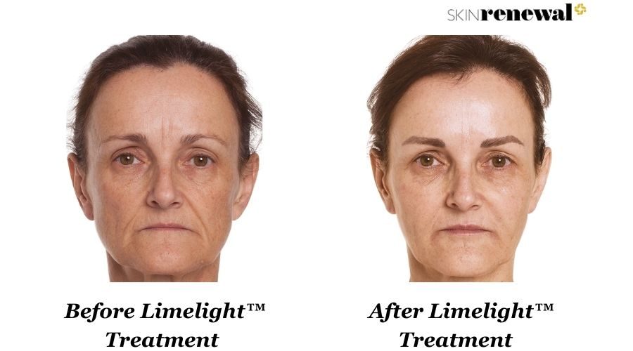 Isabel Limelight Before And After