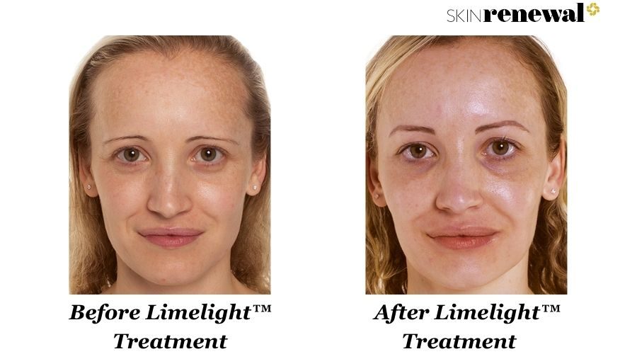 Jacoline Limelight Before And After