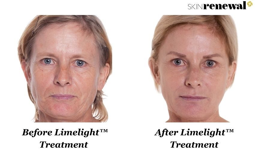 Ronel Limelight Before And After