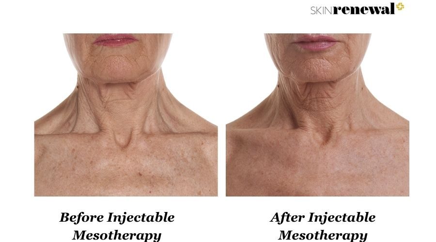 Coreen Injectable Meso Neck Before And After