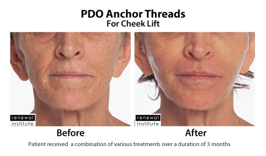 Before And After Pdo Anchor Threads For Cheek Lift
