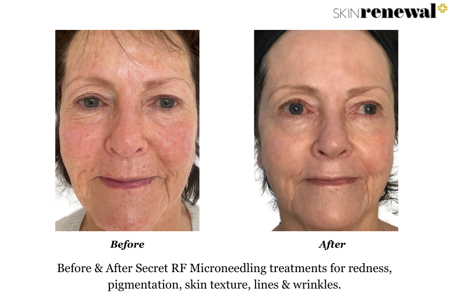 Lines Wrinkles Pigmentation Secret RF Microneedling Front Before and After