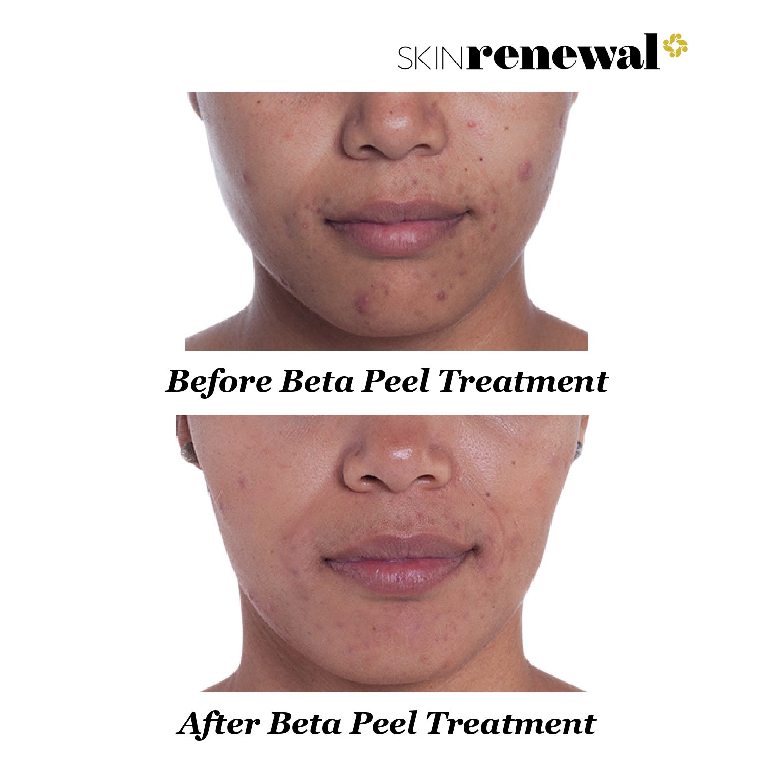 Bianca Before And After Beta Peel