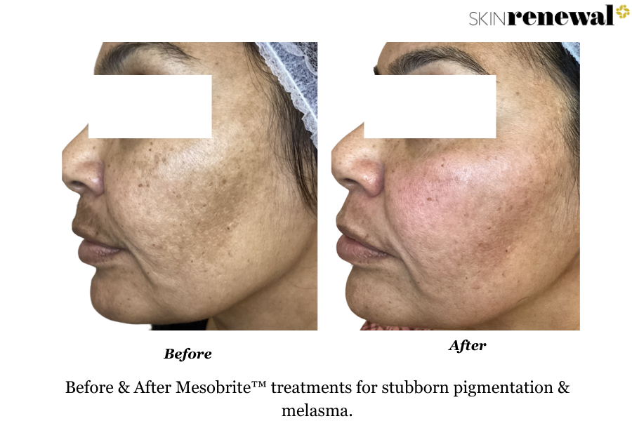 Melasma Mesobrite Left Before and After