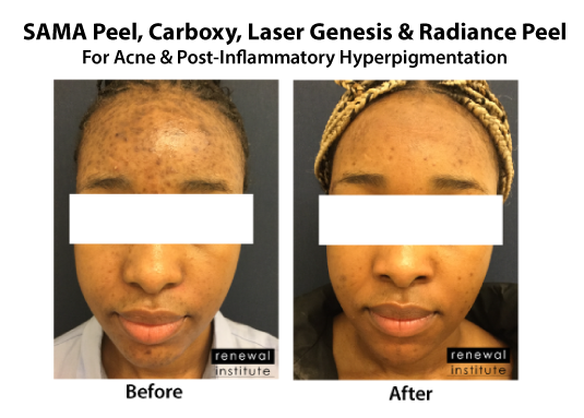 Skin Renewal Before And After Treatment For Acne And Pih Hyperpigmentation