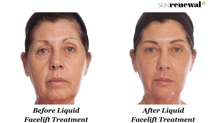 Annelise Liquid Facelift Before And After