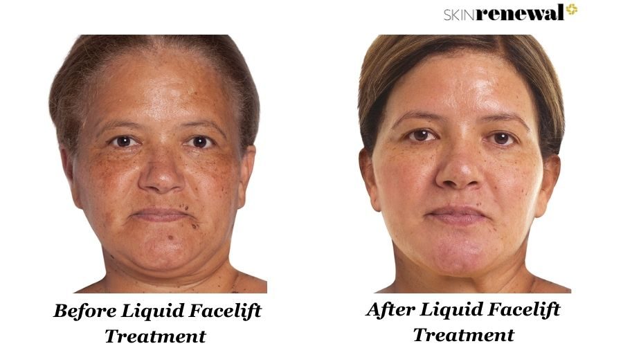 Bridget Liquid Facelift Before And After