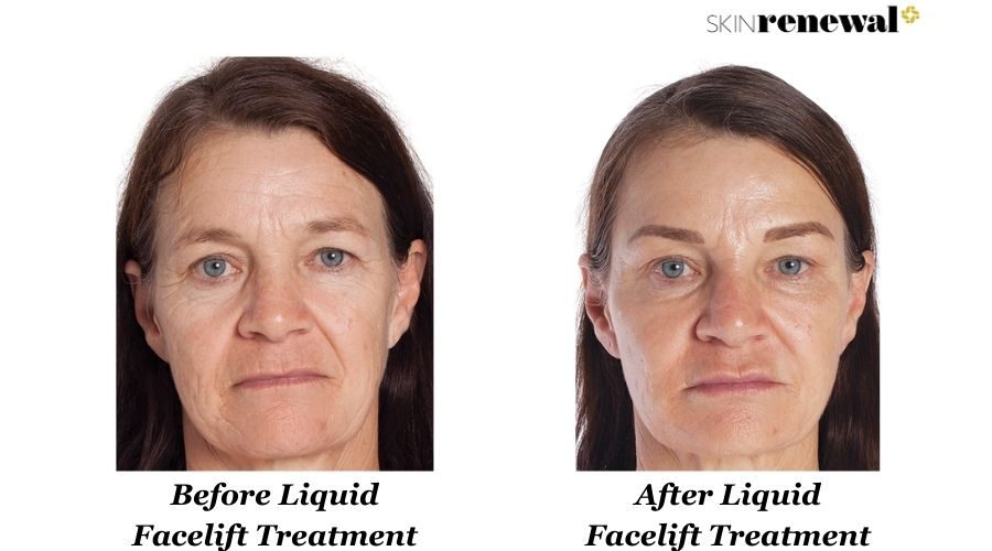 Elmarie Liquid Facelift Before And After
