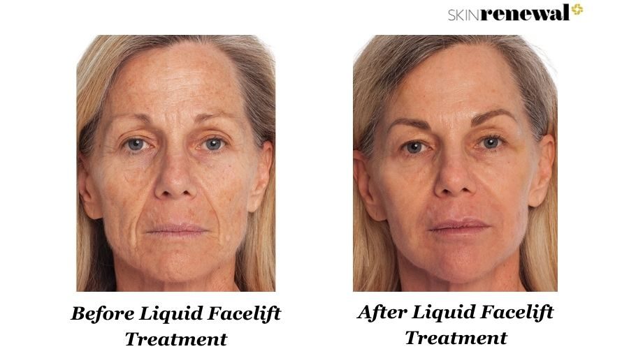 Karin Liquid Facelift Before And After