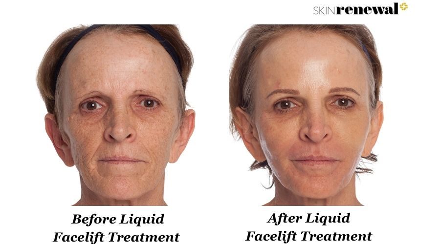 Liana Liquid Facelift Before And After