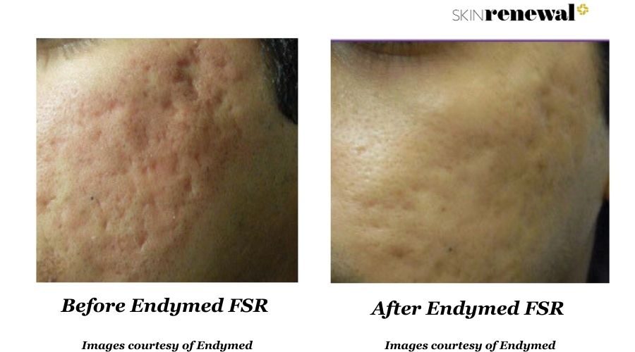 Endymed Fsr Scars