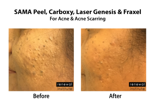 Skin Renewal Before And After Treatment For Acne And Scarring