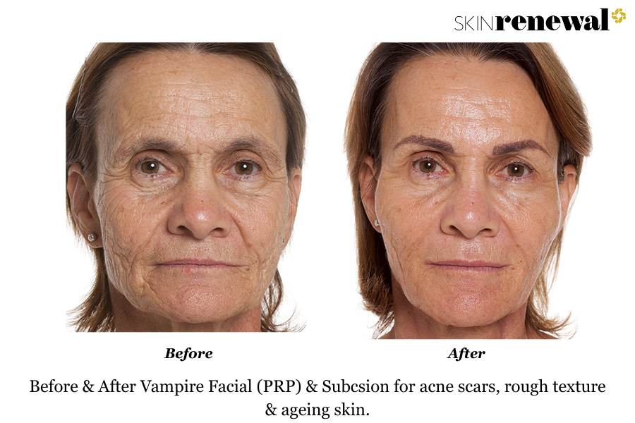 Acne Scars PRP Subcision Before and After
