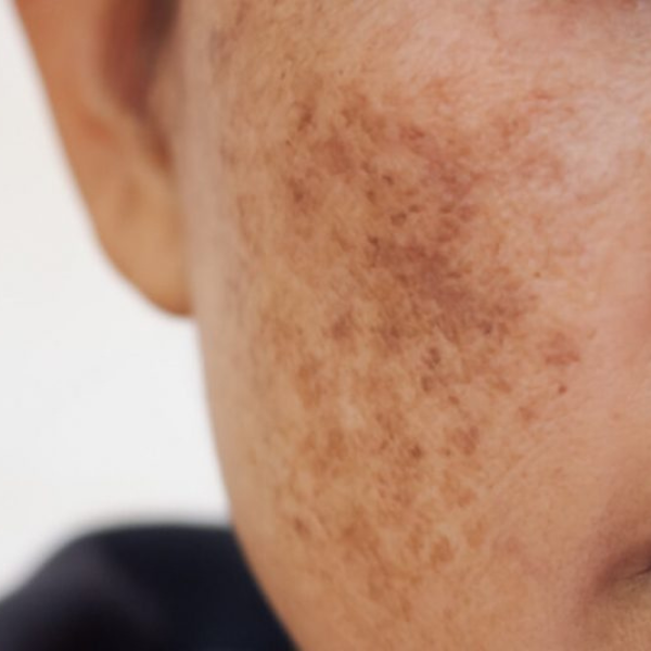 Melasma & Deep Pigmentation Solutions