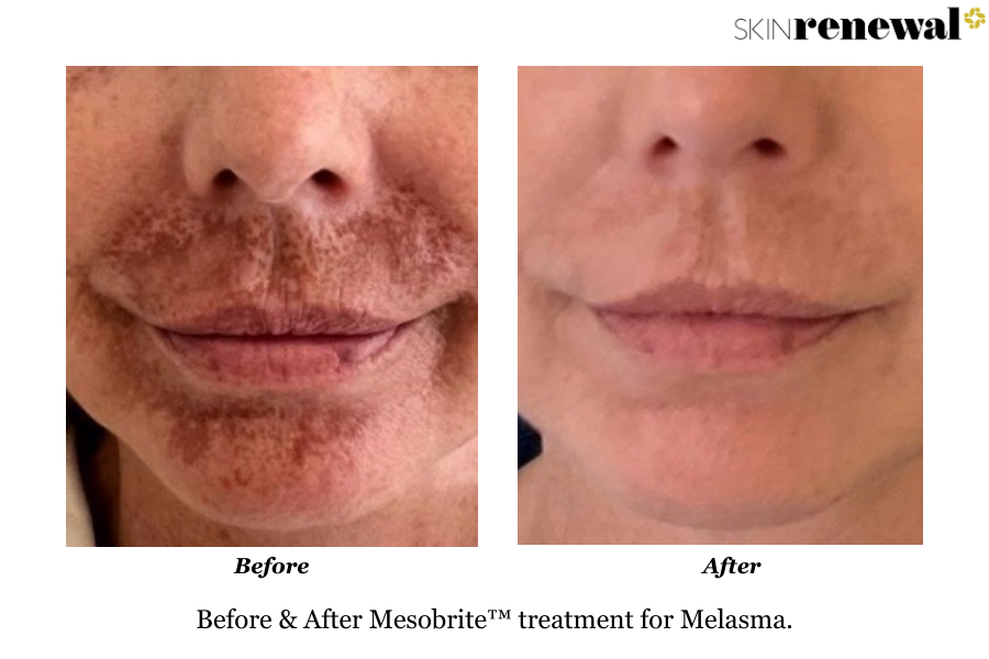 Melasma Mesobrite Before and After