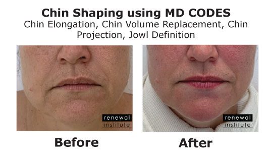 Md Codes Before And After Chin Shaping With Fillers Female