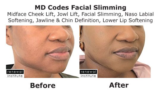 Md Codes Before And After Facial Slimming Dark Skin Fillers Female