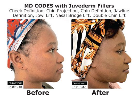 Md Codes Before And After Facial Slimming Dark Skin Juvederm Fillers Female
