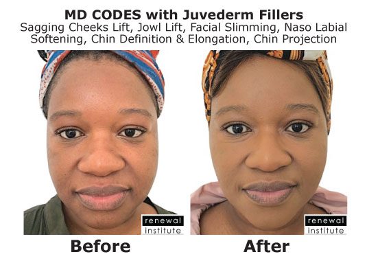 Md Codes Before And After Female Using Fillers Non Surgical