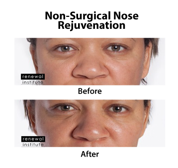 Before And After Non Surgical Nose Job