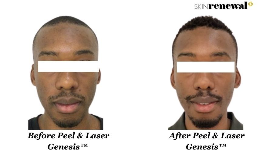 Peel Laser Genesis Front