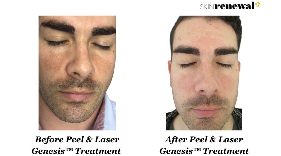 Peel Laser Genesis Pdt Front