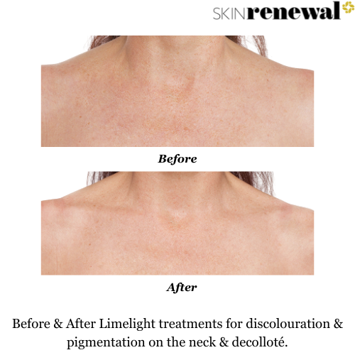 Pigmentation Dark Marks Limelight Before and After