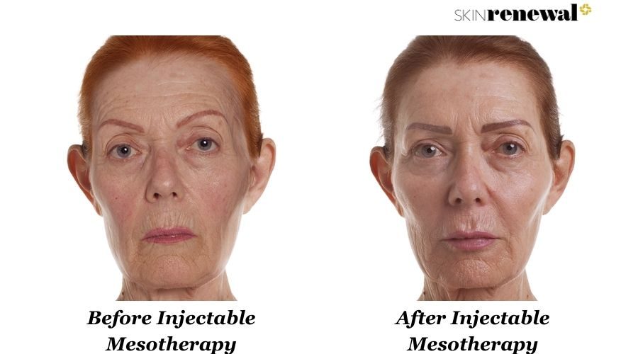 Coreen Injectable Meso Face Before And After