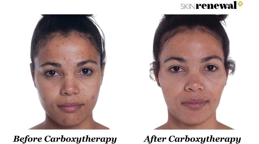 Bianca Carboxytherapy Before And After