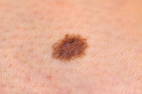 Pre Cancerous Skin Lesions Skin Cancer Prevention