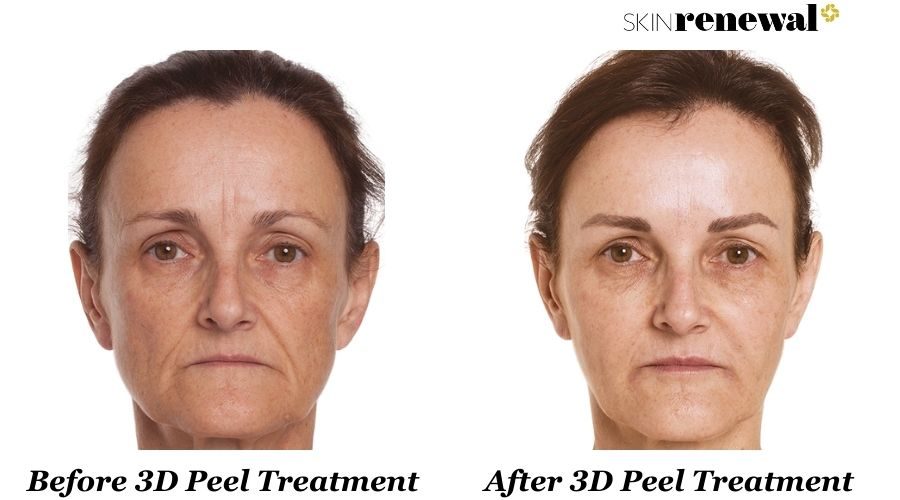 Isabel 3d Peel Before And After