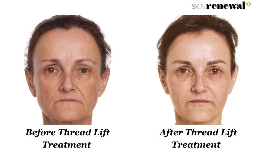Isabel Thread Lift Before And After