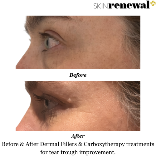 Tear Trough Dermal Fillers Before and After