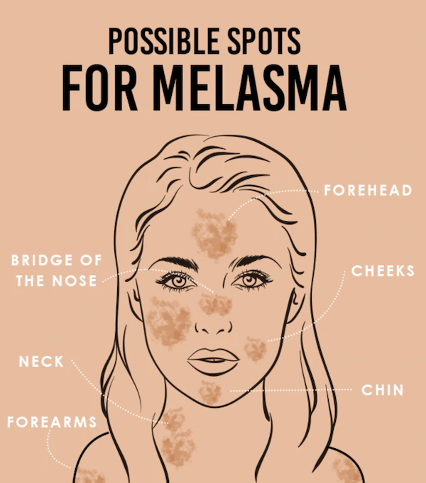 areas Melasma appears skin renewal