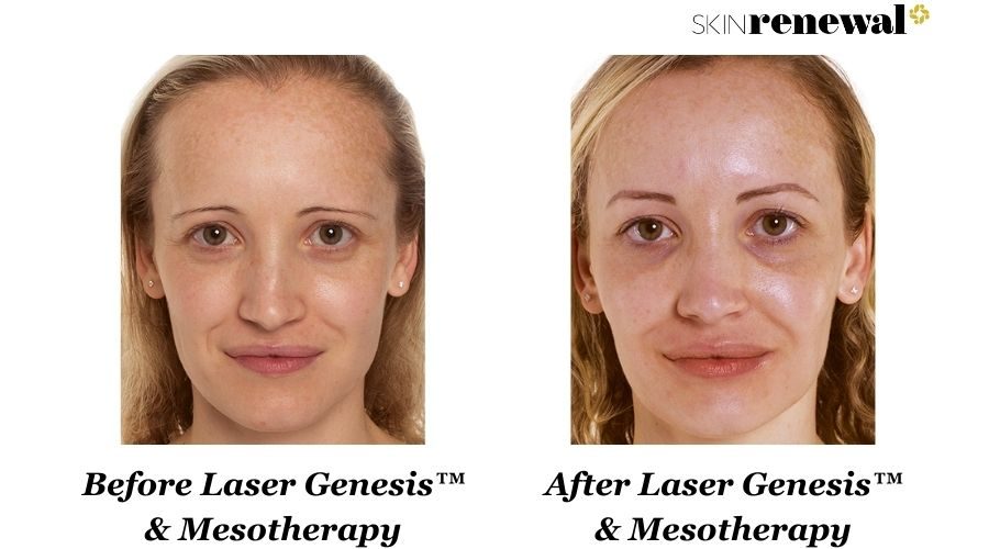 Jacoline Laser Genesis Mesotherapy Before And After