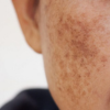 Outsmarting Melasma: Staying Ahead of Dynamic Pigmentation