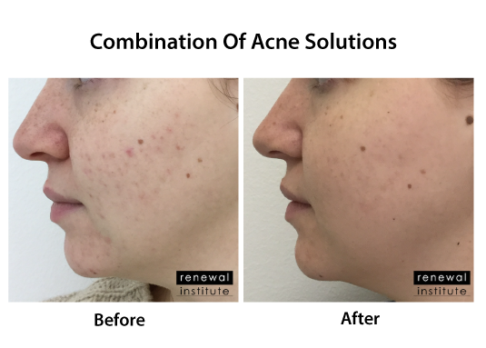 Skin Renewal Before And After Treatment For Acne