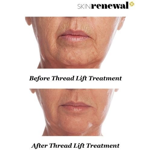 Anelise Before And After Thread Lift
